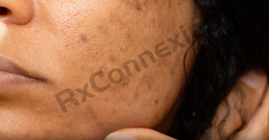 Video - Tri-Luma The Dermatologist's Secret for Melasma MEL101